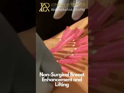 Successful Non-surgical breast enhancement &Lifting procedure done with Dermal Fillers & PDO Threads