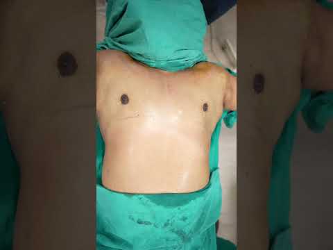 Gynecomastia Surgery #shortvideo #dezireclinicindia