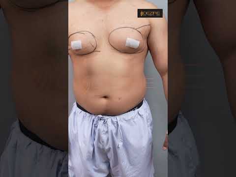 Gynecomastia Marking