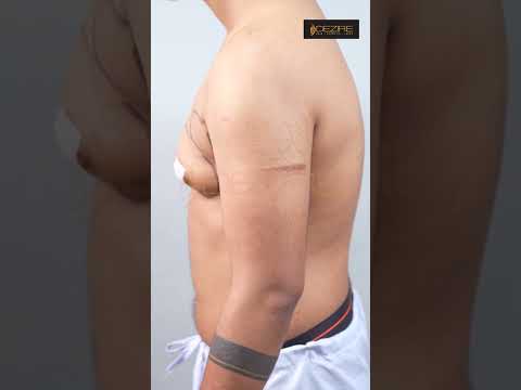 Gynecomastia surgery result