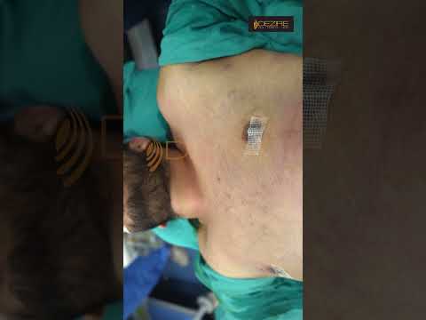 Gynecomastia surgery result